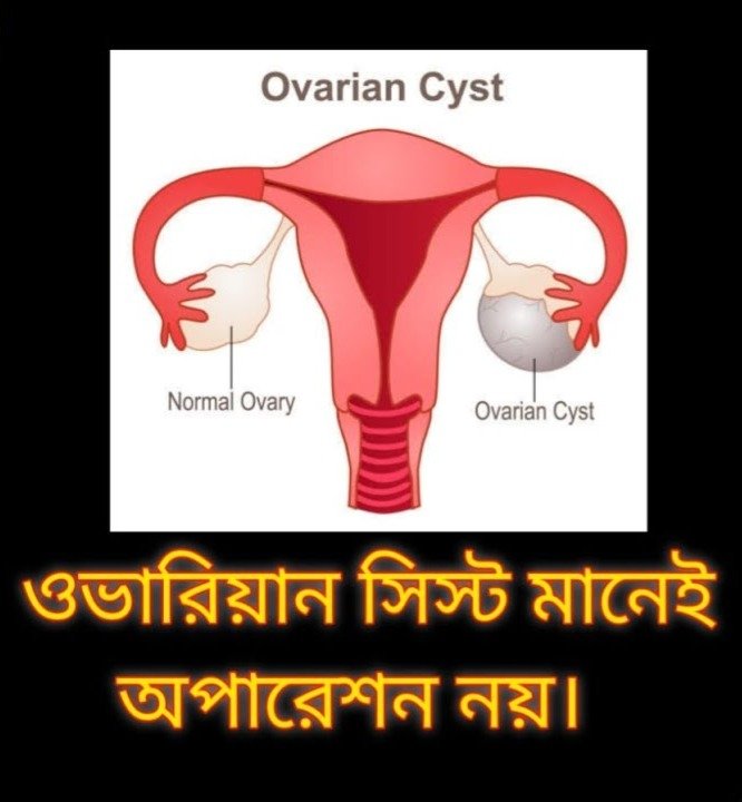 ওভারি তে সিস্ট (PCOD/Ovarian Cyst)