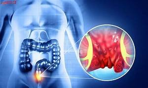 HEMORRHOIDS (পাইলস)