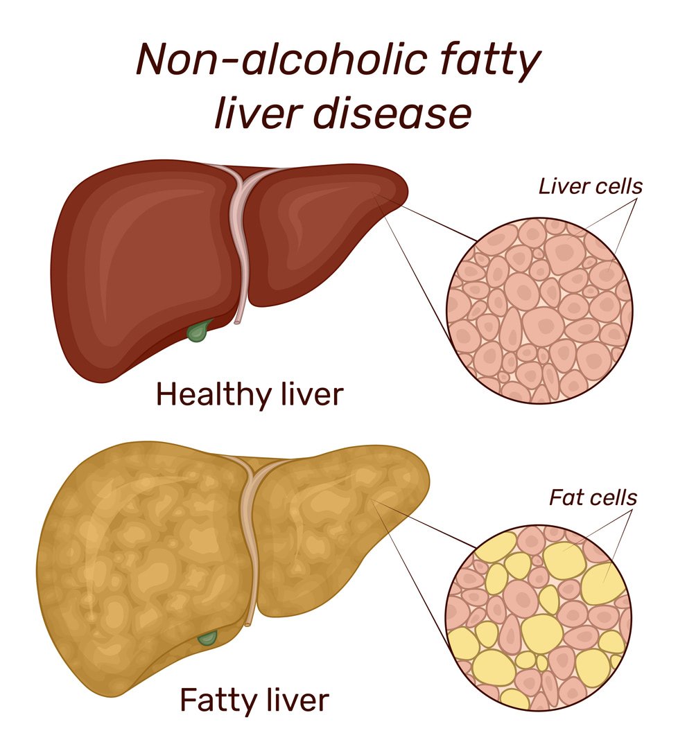 FATTY LIVER (ফ্যাটি লিভার)